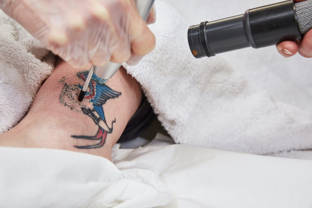 Tattoo Removal South Wales